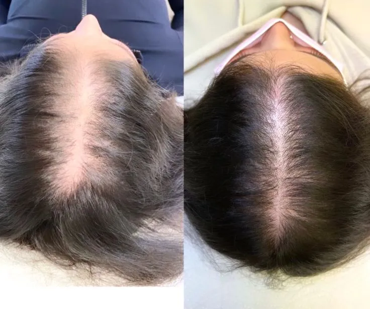 Hairline Reconstruction