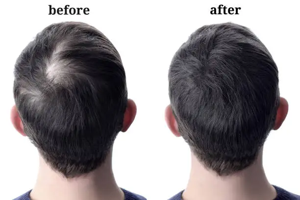 Eyebrow Reconstruction
