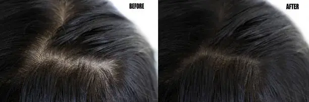 Hair Transplant in Indores