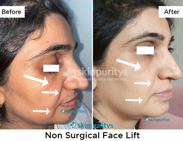 Threadlift results