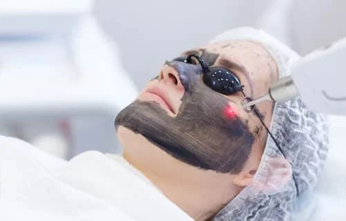 Carbon Laser Peel Treatment in Indore