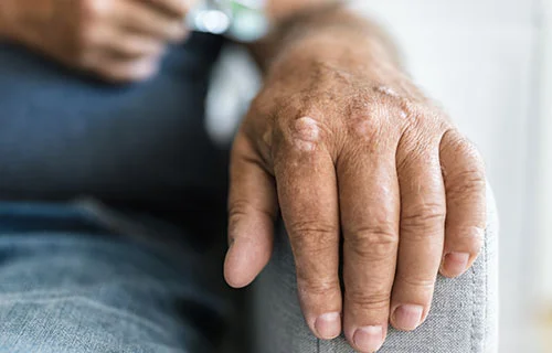 Psoriasis Treatment in Indore