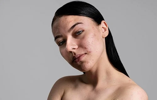 Acne & Scars Treatment